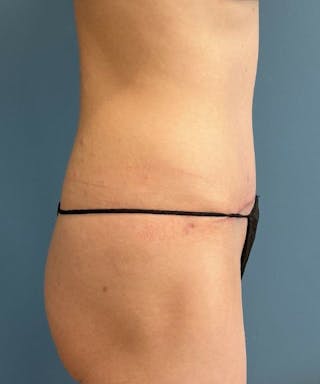 Tummy Tuck Before & After Gallery - Patient 416824 - Image 4