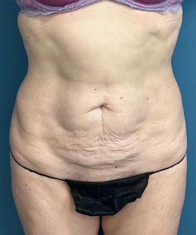 Tummy Tuck Before & After Gallery - Patient 304245 - Image 1