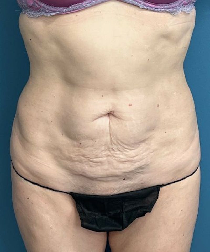 Tummy Tuck Before & After Gallery - Patient 304245 - Image 1