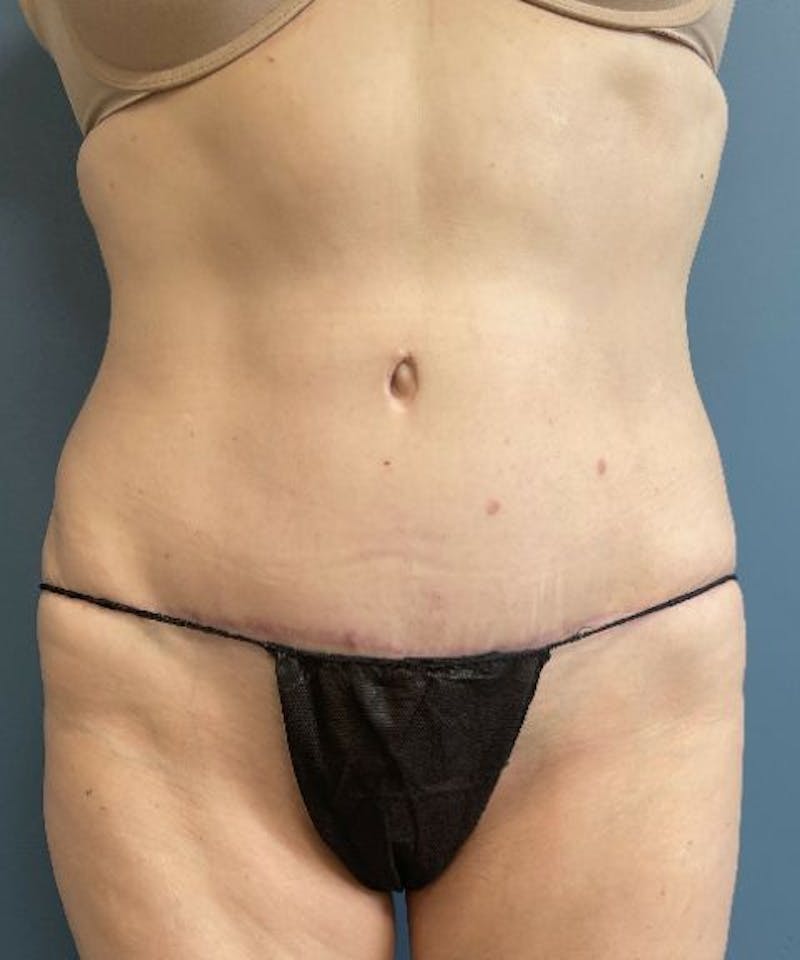 Tummy Tuck Before & After Gallery - Patient 304245 - Image 2
