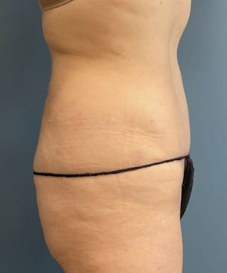Tummy Tuck Before & After Gallery - Patient 304245 - Image 4