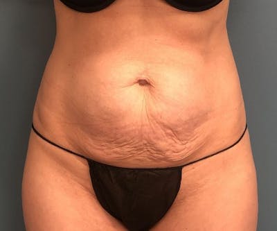 Tummy Tuck Before & After Gallery - Patient 397836 - Image 1