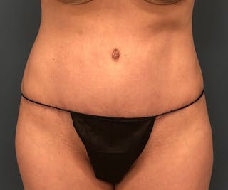 Tummy Tuck Before & After Gallery - Patient 397836 - Image 2