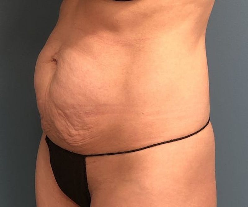 Tummy Tuck Before & After Gallery - Patient 397836 - Image 3