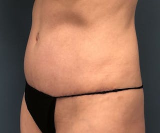 Tummy Tuck Before & After Gallery - Patient 397836 - Image 4