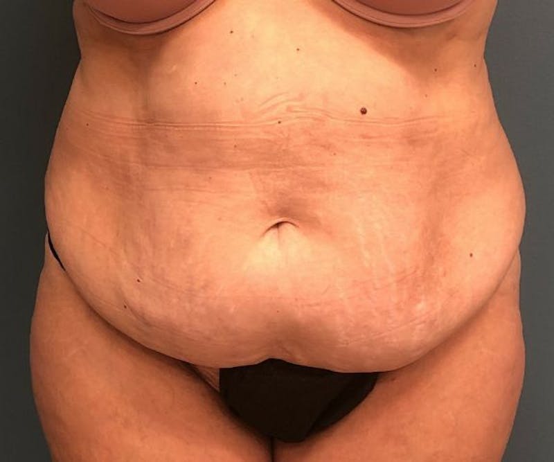 Tummy Tuck Before & After Gallery - Patient 282277 - Image 1