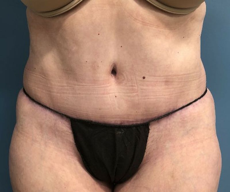 Tummy Tuck Before & After Gallery - Patient 282277 - Image 2