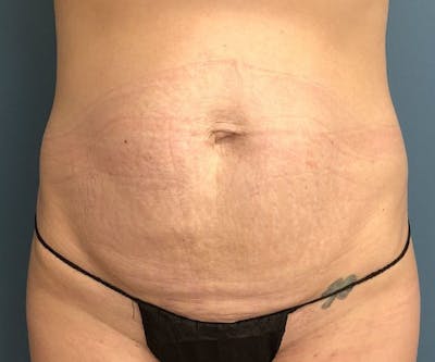 Tummy Tuck Before & After Gallery - Patient 250431 - Image 1