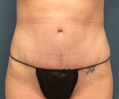 Tummy Tuck Before & After Gallery - Patient 250431 - Image 2