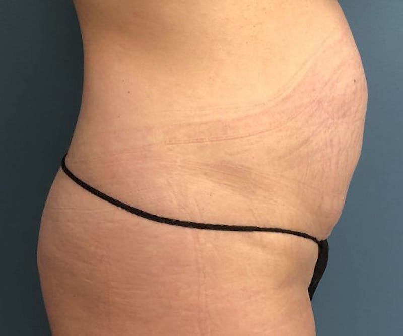 Tummy Tuck Before & After Gallery - Patient 250431 - Image 3