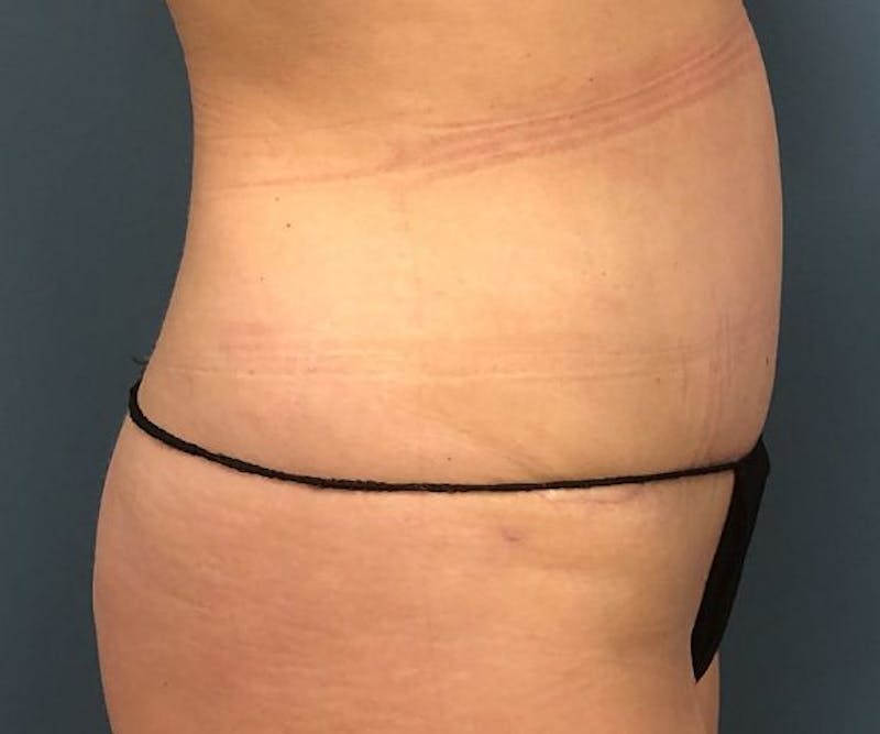 Tummy Tuck Before & After Gallery - Patient 250431 - Image 4