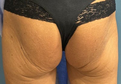 Sculptra for the Body Before & After Gallery - Patient 387174 - Image 1