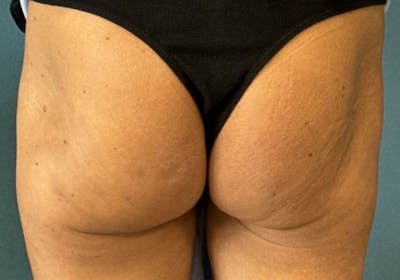 Sculptra for the Body Before & After Gallery - Patient 387174 - Image 2