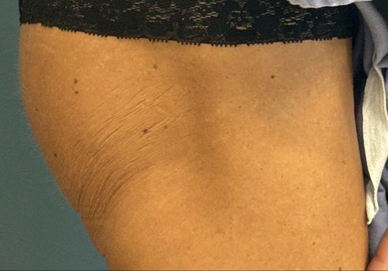 Sculptra for the Body Before & After Gallery - Patient 387174 - Image 3