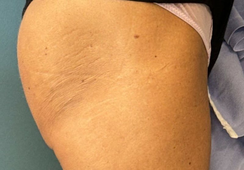 Sculptra for the Body Before & After Gallery - Patient 387174 - Image 4