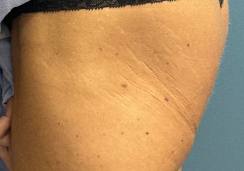 Sculptra for the Body Before & After Gallery - Patient 387174 - Image 5