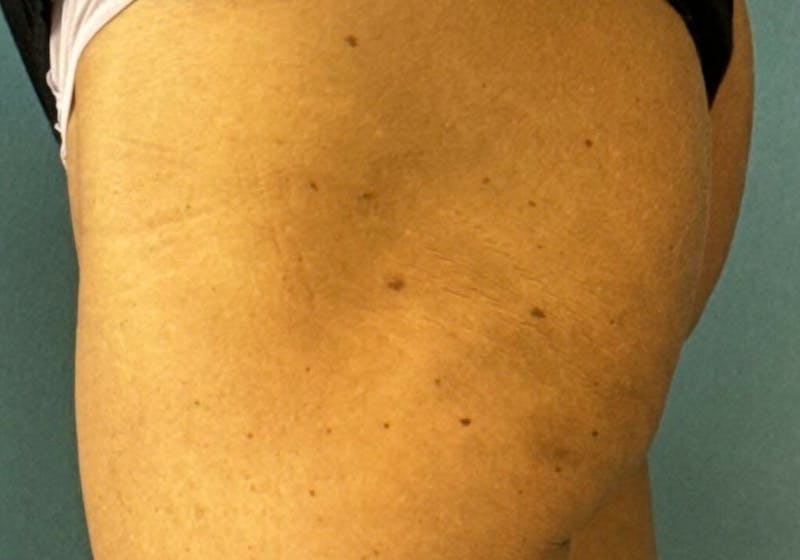 Sculptra for the Body Before & After Gallery - Patient 387174 - Image 6