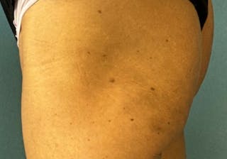 Sculptra for the Body Before & After Gallery - Patient 387174 - Image 6