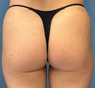 Sculptra for the Body Before & After Gallery - Patient 394014 - Image 2