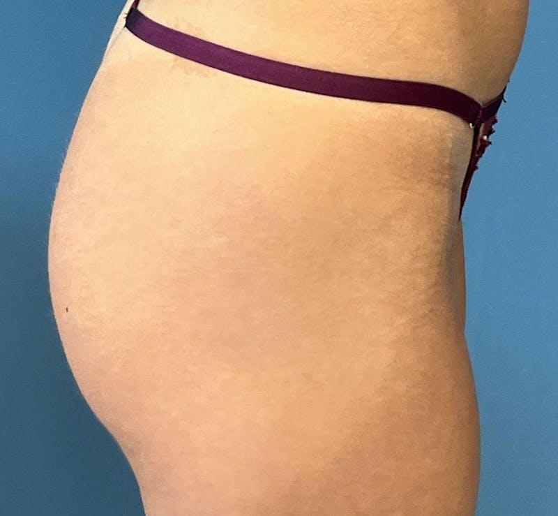 Sculptra for the Body Before & After Gallery - Patient 394014 - Image 3