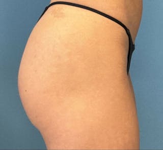 Sculptra for the Body Before & After Gallery - Patient 394014 - Image 4