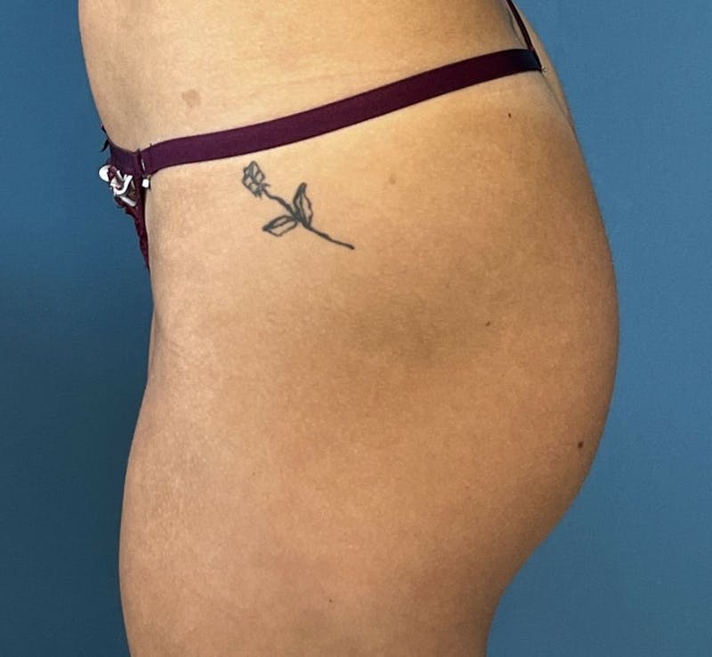 Sculptra for the Body Before & After Gallery - Patient 394014 - Image 5