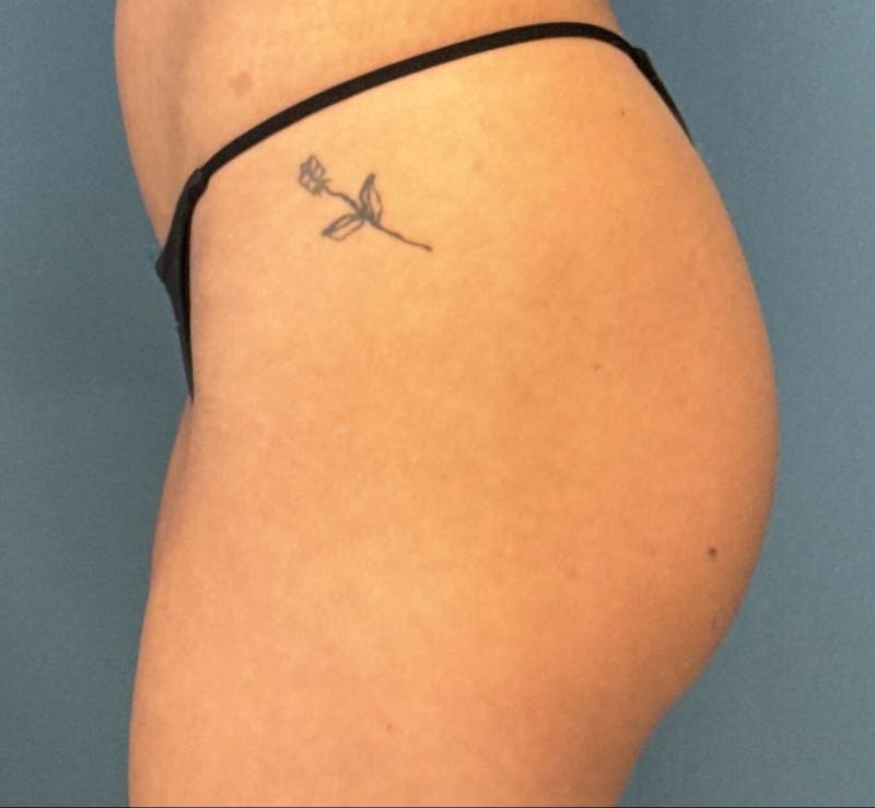 Sculptra for the Body Before & After Gallery - Patient 394014 - Image 6