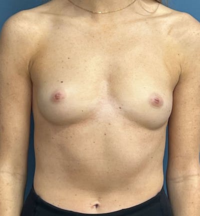 Breast Augmentation Before & After Gallery - Patient 103437 - Image 1