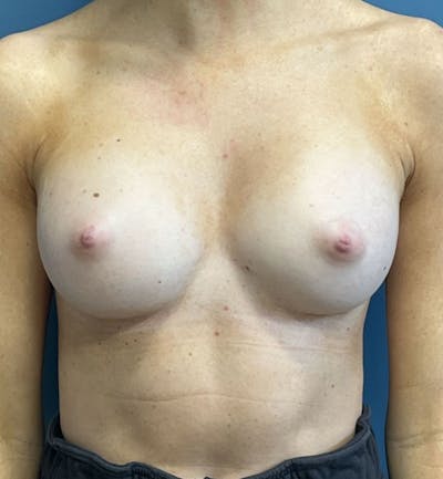 Breast Augmentation Before & After Gallery - Patient 103437 - Image 2