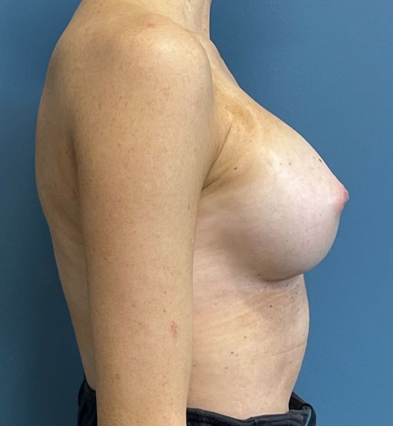 Breast Augmentation Before & After Gallery - Patient 103437 - Image 4