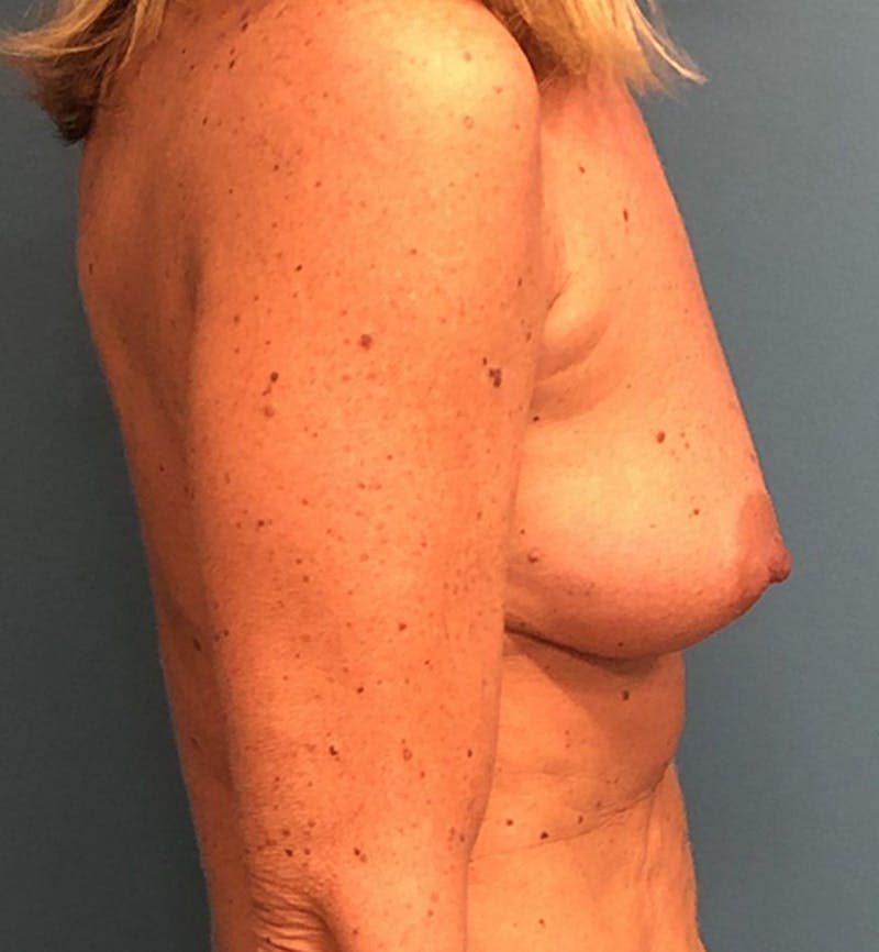 Breast Augmentation Before & After Gallery - Patient 872092 - Image 3