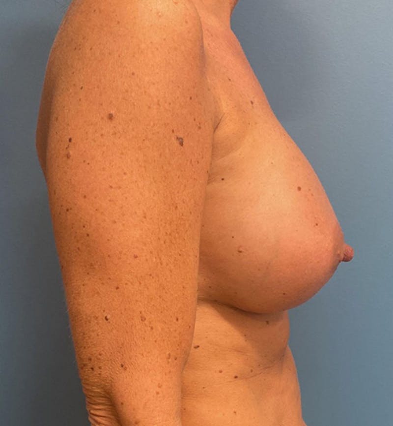 Breast Augmentation Before & After Gallery - Patient 872092 - Image 4