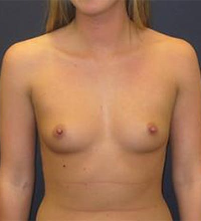Breast Augmentation Before & After Gallery - Patient 108404 - Image 1