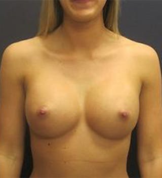 Breast Augmentation Before & After Gallery - Patient 108404 - Image 2