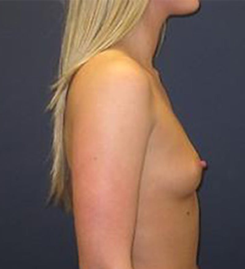 Breast Augmentation Before & After Gallery - Patient 108404 - Image 3