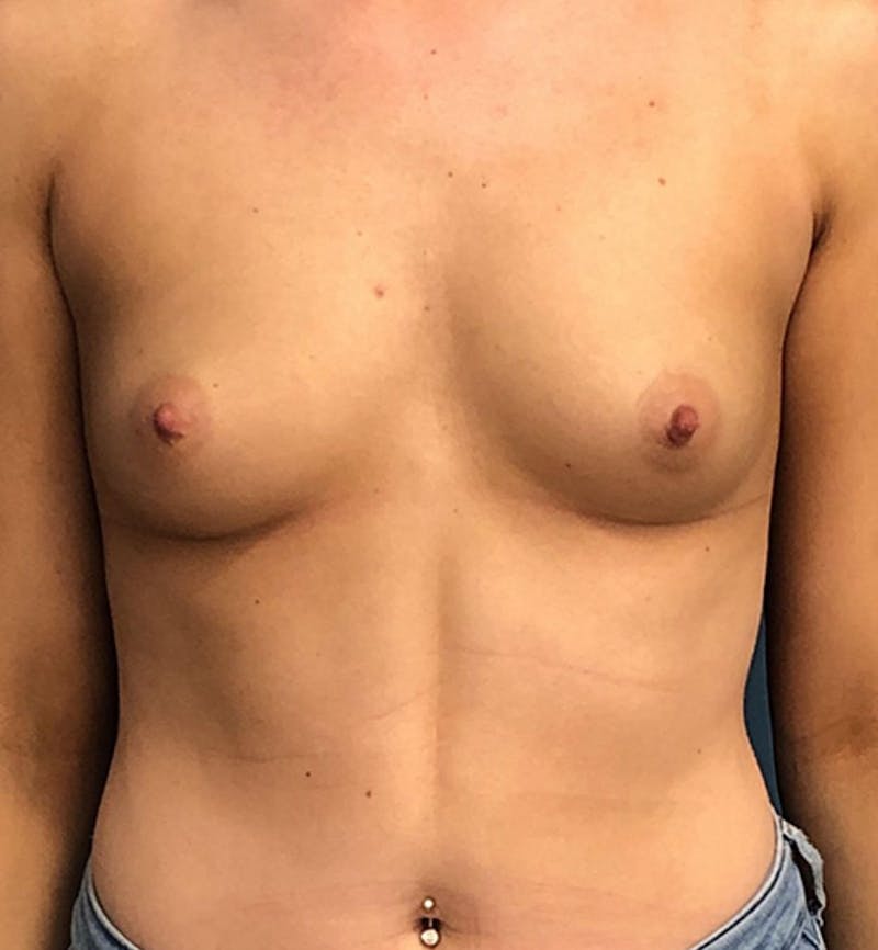 Breast Augmentation Before & After Gallery - Patient 286234 - Image 1