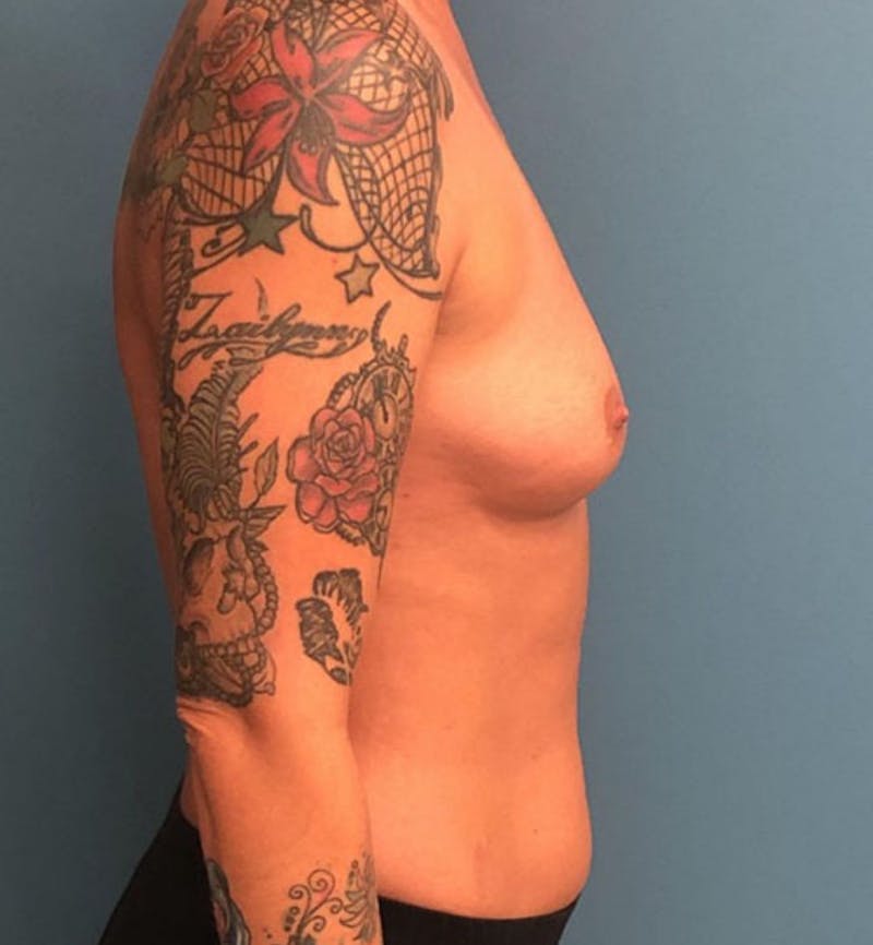 Breast Augmentation Before & After Gallery - Patient 110005 - Image 3