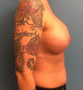 Breast Augmentation Before & After Gallery - Patient 110005 - Image 4