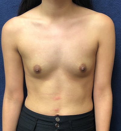 Breast Augmentation Before & After Gallery - Patient 365353 - Image 1