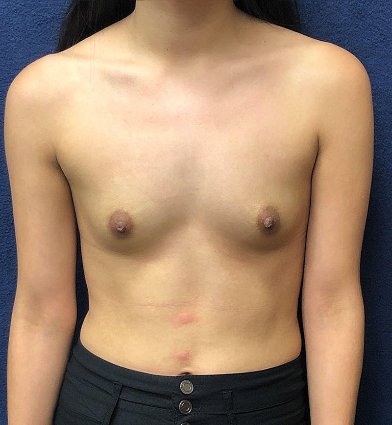 Breast Augmentation Before & After Gallery - Patient 365353 - Image 1