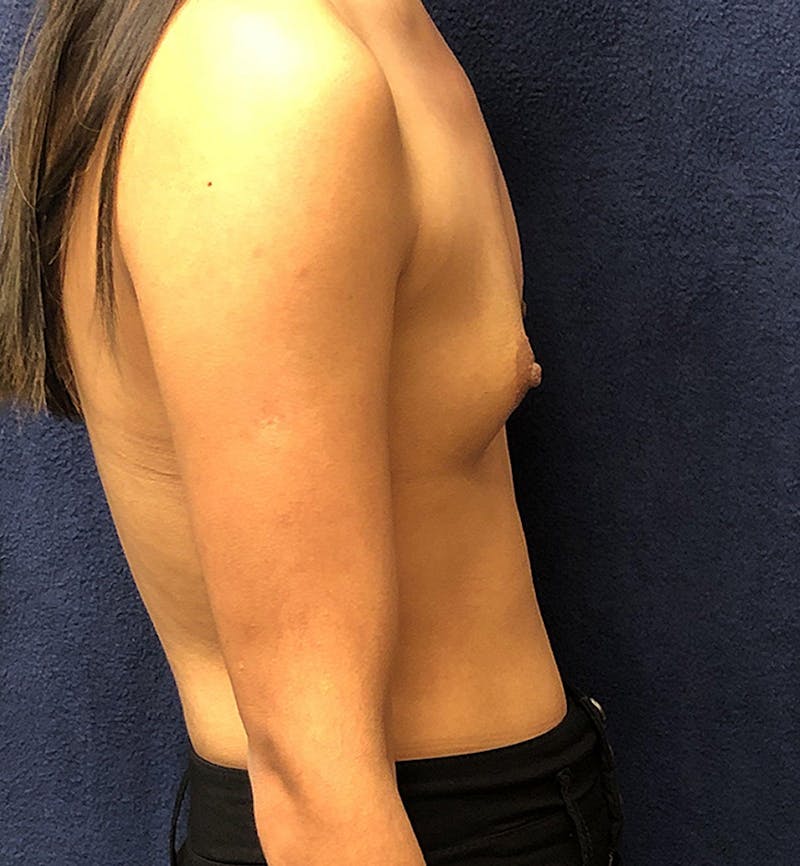 Breast Augmentation Before & After Gallery - Patient 365353 - Image 3