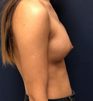 Breast Augmentation Before & After Gallery - Patient 365353 - Image 4