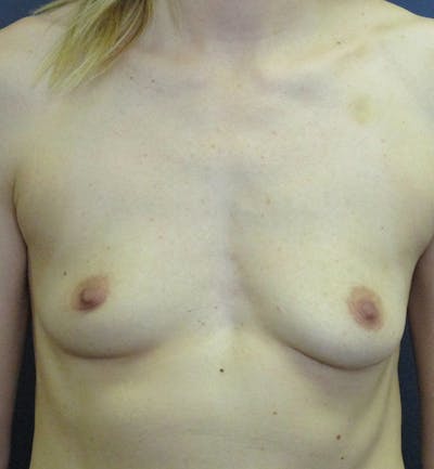 Breast Augmentation Before & After Gallery - Patient 155942 - Image 1