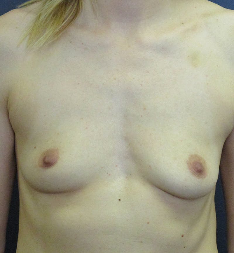Breast Augmentation Before & After Gallery - Patient 155942 - Image 1
