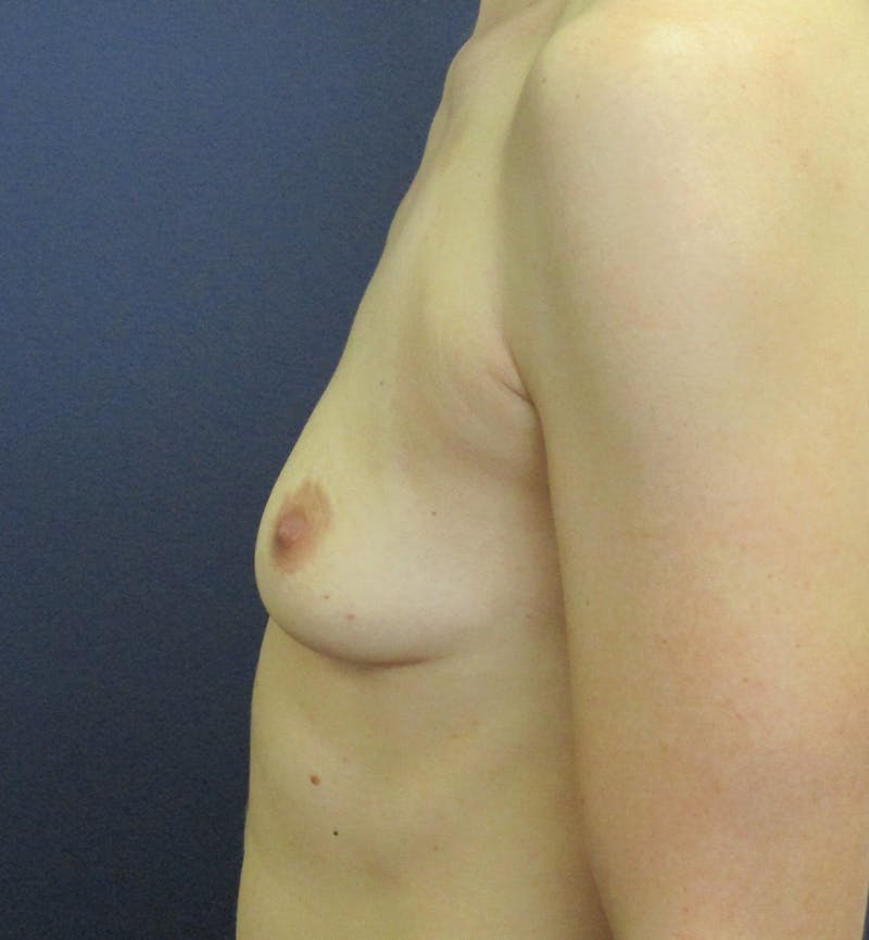 Breast Augmentation Before & After Gallery - Patient 155942 - Image 3