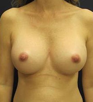 Breast Augmentation Before & After Gallery - Patient 392017 - Image 2
