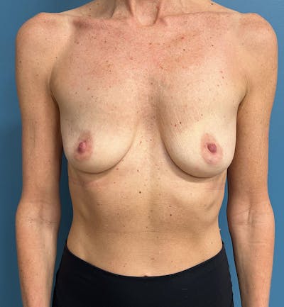 Breast Augmentation Before & After Gallery - Patient 285995 - Image 1