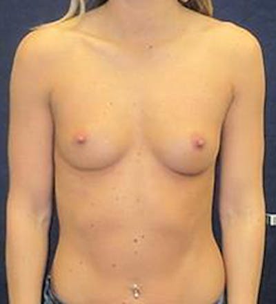 Breast Augmentation Before & After Gallery - Patient 128913 - Image 1