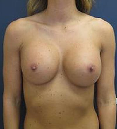 Breast Augmentation Before & After Gallery - Patient 128913 - Image 2