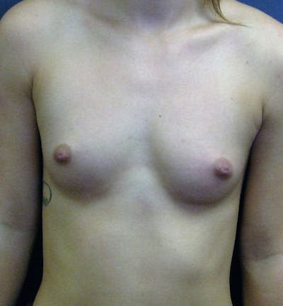 Breast Augmentation Before & After Gallery - Patient 402119 - Image 1